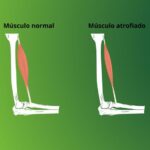 Atrofia e hipertrofia muscular: entenda como esses processos impactam sua saúde